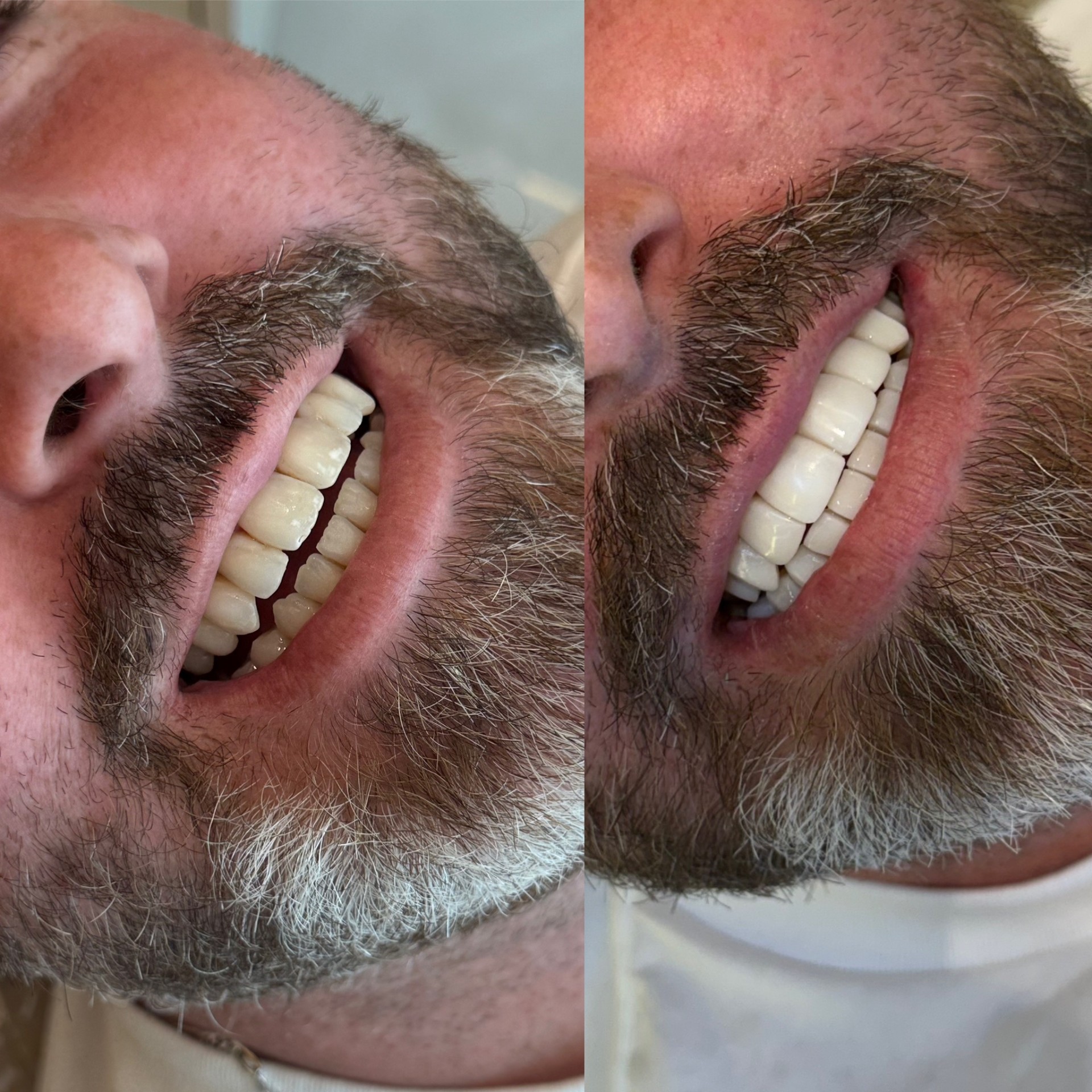 Facetas em porcelana