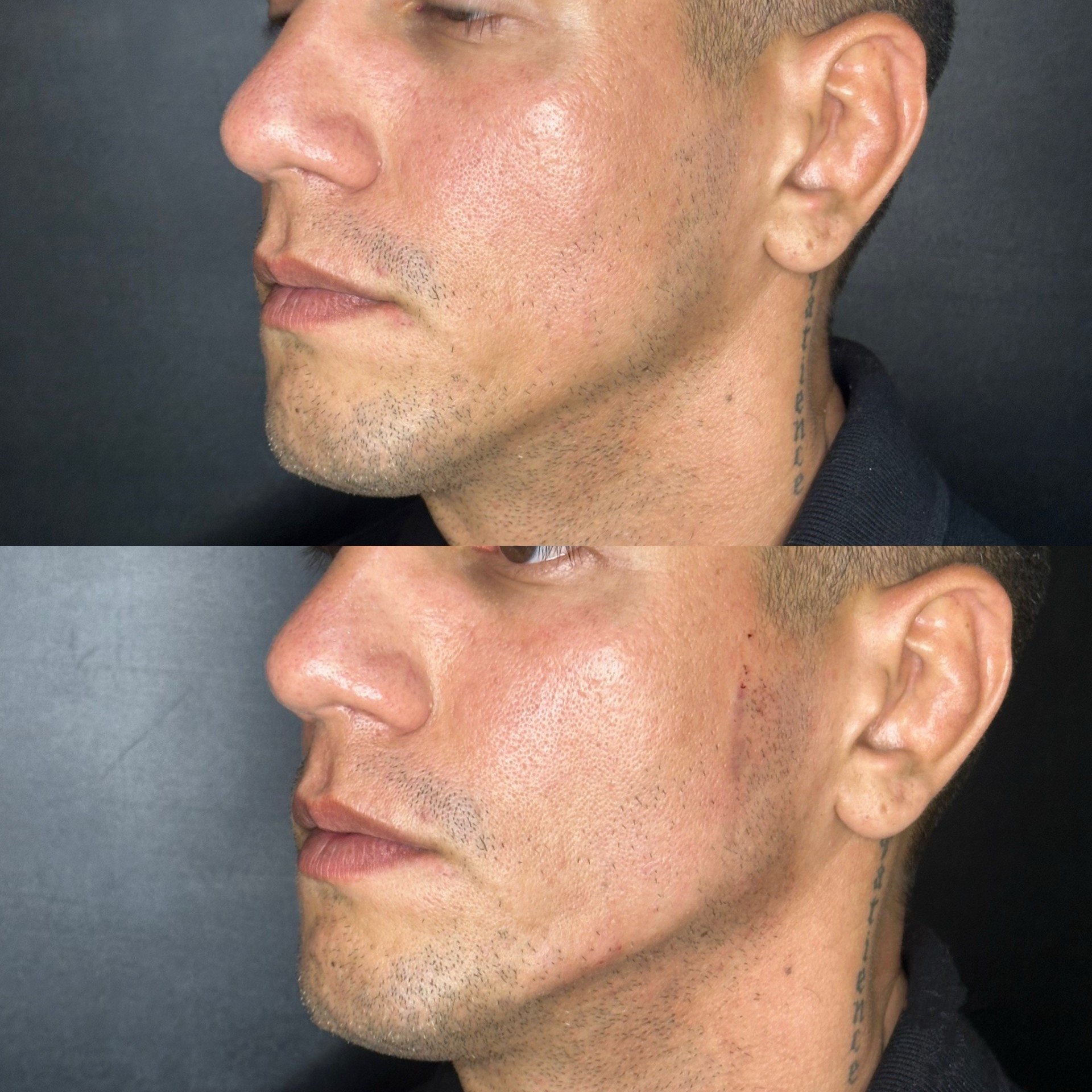 Harmonização facial